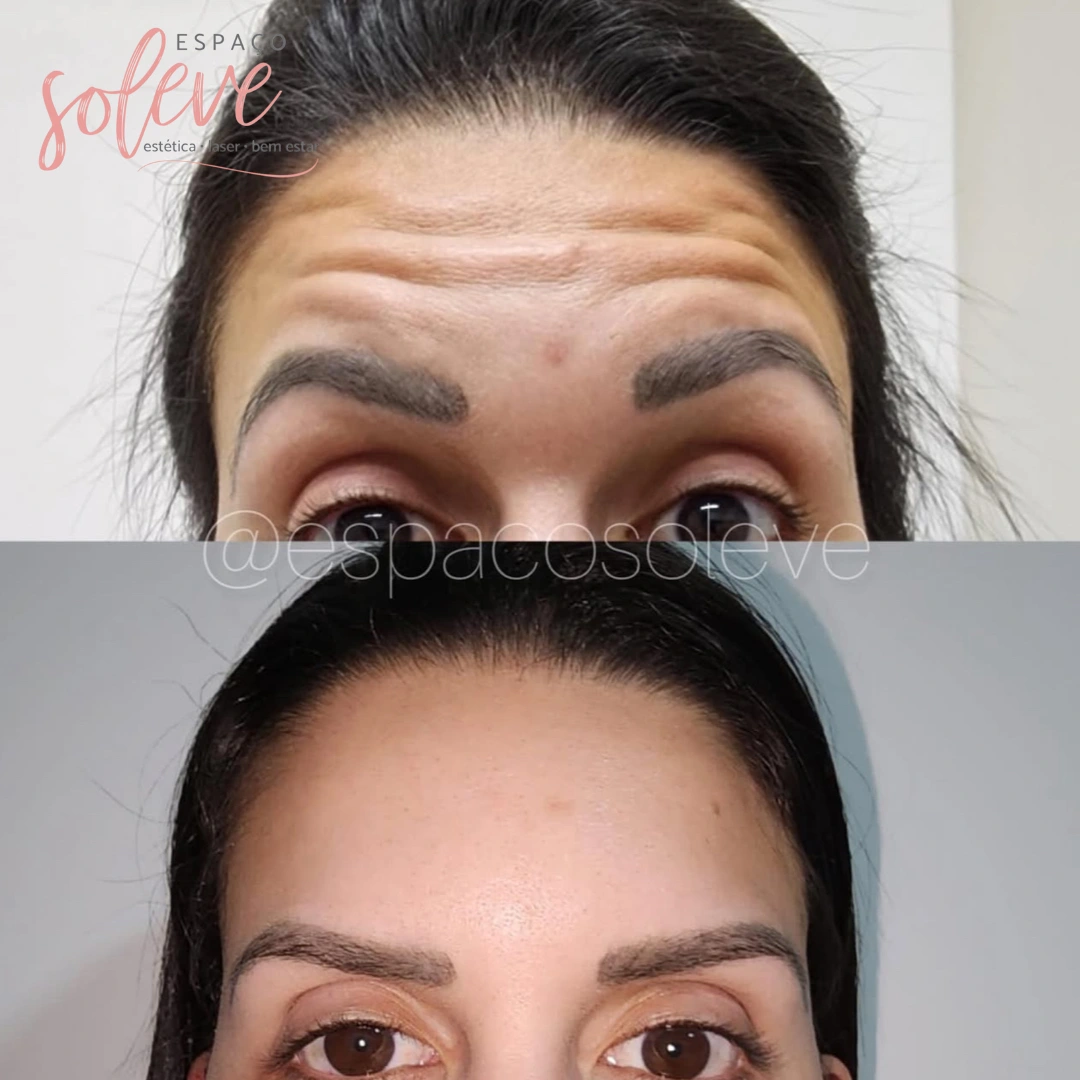 antesedepois5